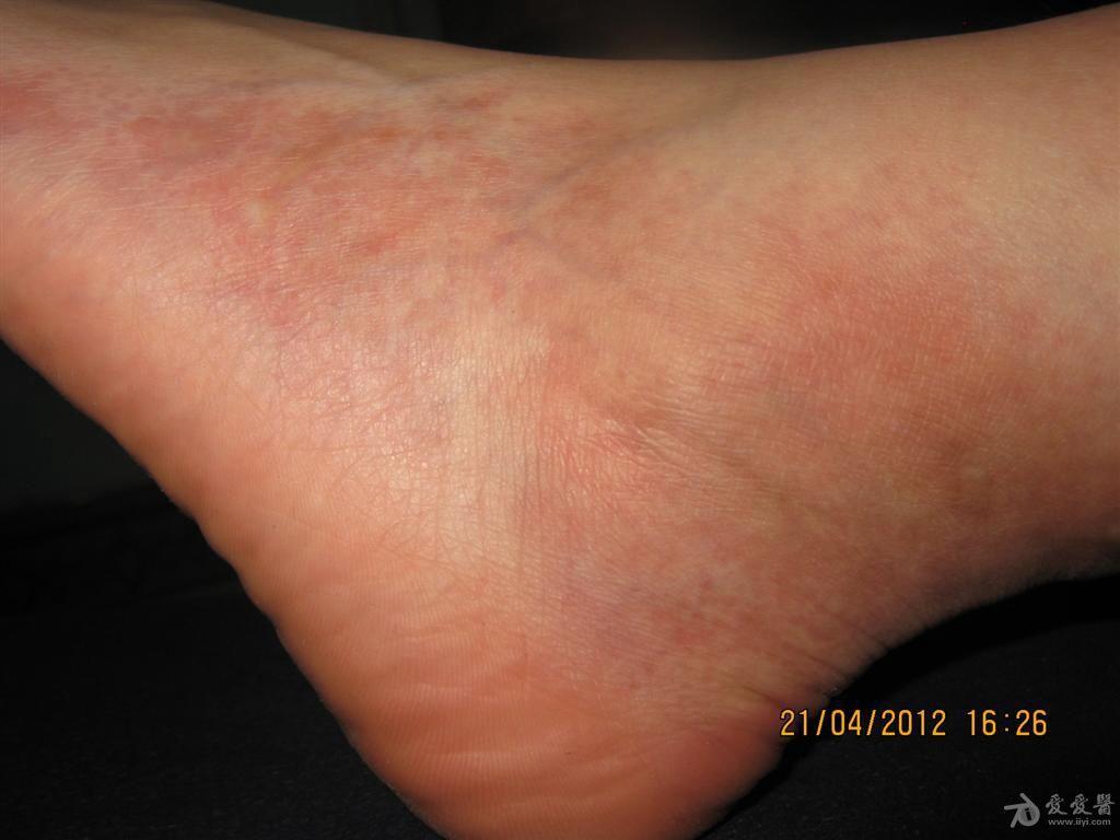 看图识病局限性硬皮病