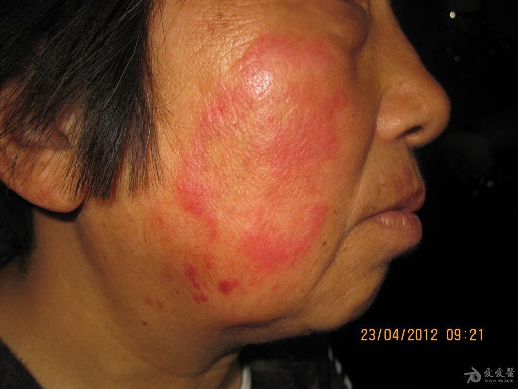 病例分享--------------------面癣