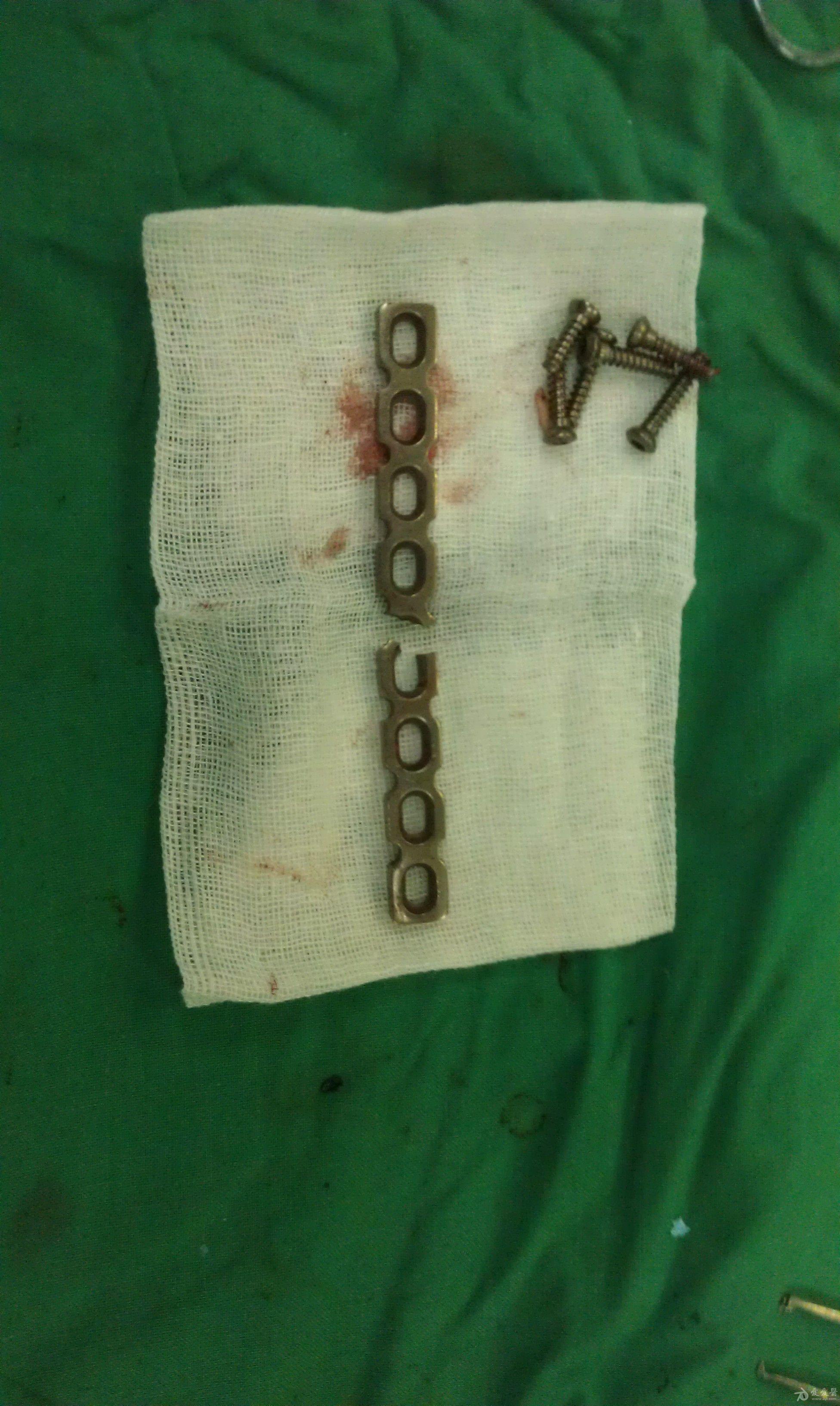 锁骨骨折用的钢板图片图片