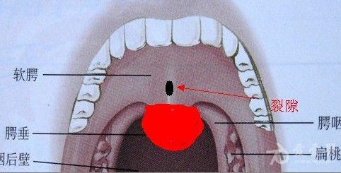 口咽部的小裂口