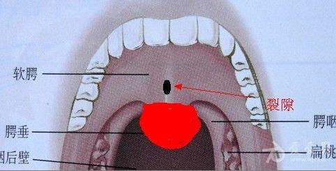 腭垂有白点图片
