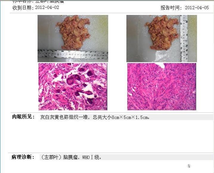 仰卧侧头,左额颞马蹄形切口,游离骨瓣开颅,见颅骨受肿瘤侵蚀,约3*4 cm