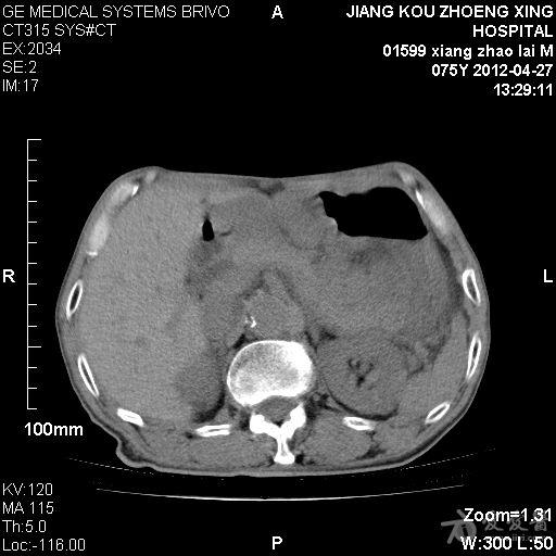 胆囊结石伴慢性胆囊炎急性发作胆囊穿孔