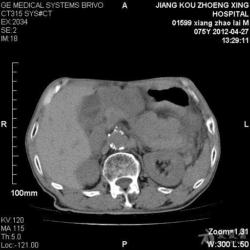 膽囊結石伴慢性膽囊炎急性發作膽囊穿孔