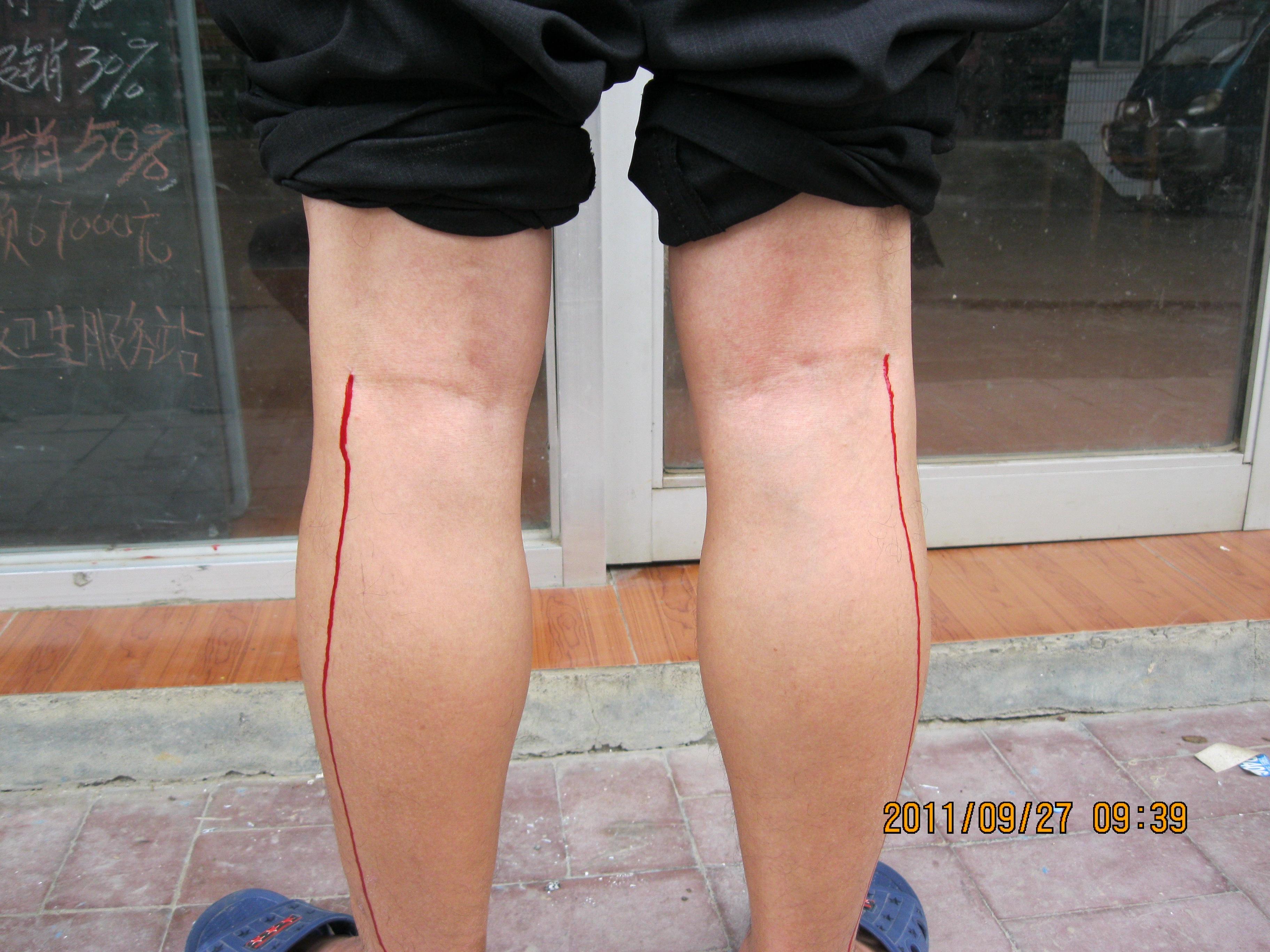 刺血疗法治疗急性腰扭伤