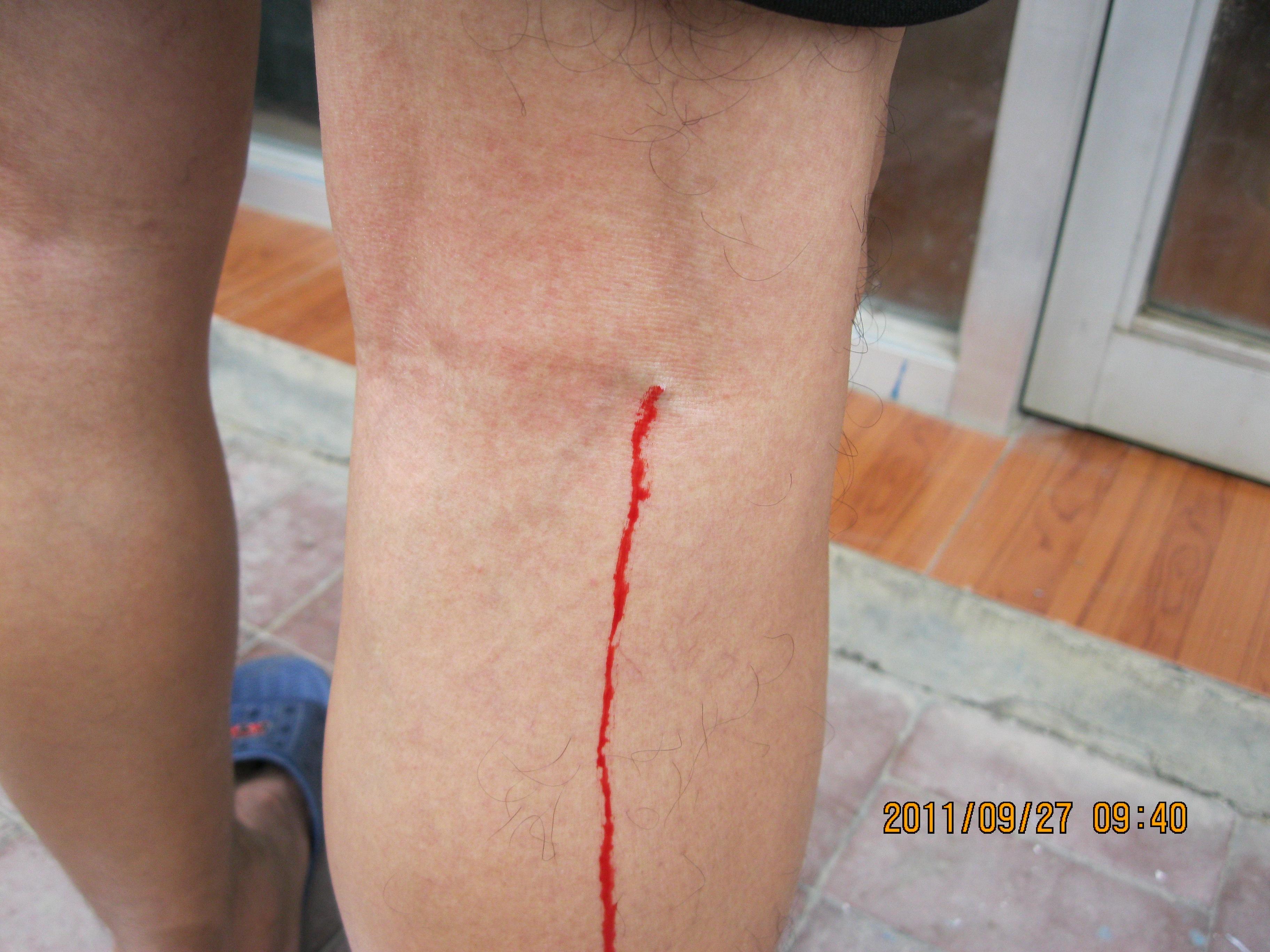 刺血疗法治疗急性腰扭伤