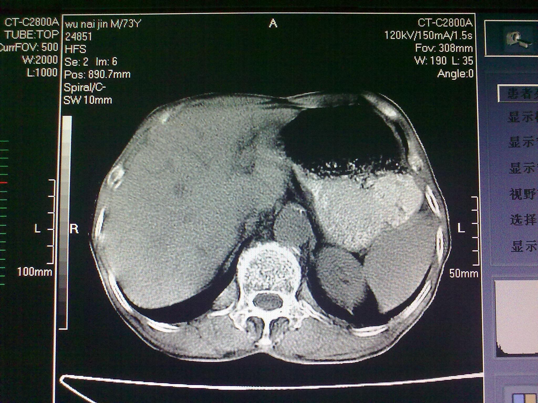 上腹部CT平扫图片