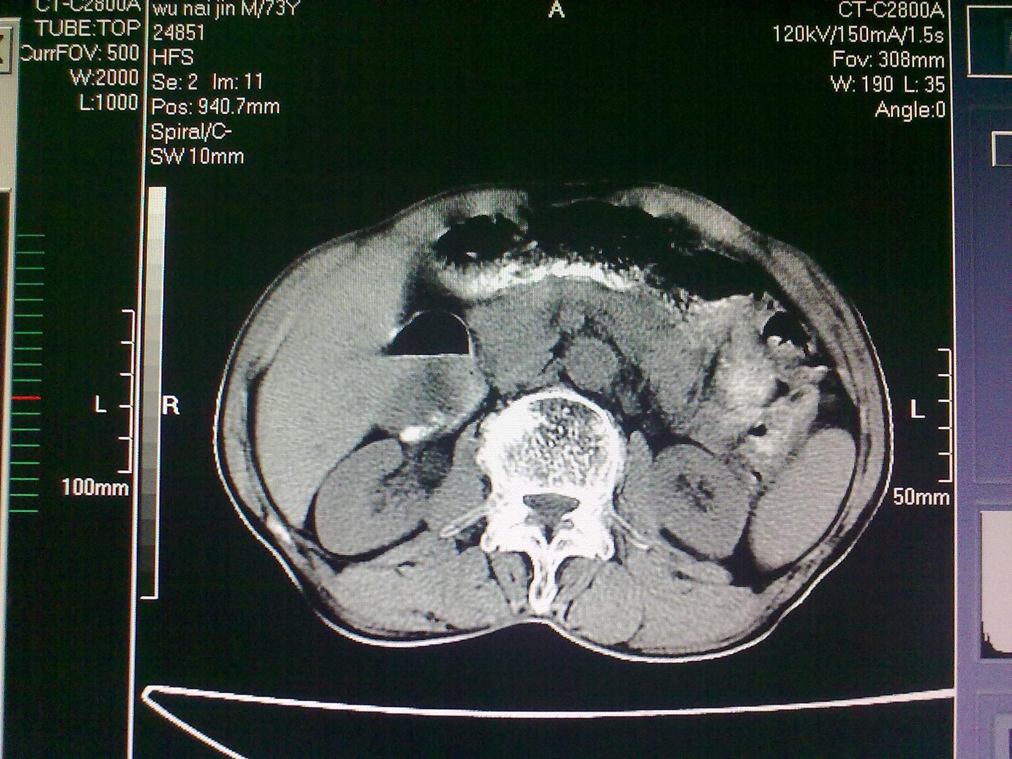 上腹部CT平扫图片