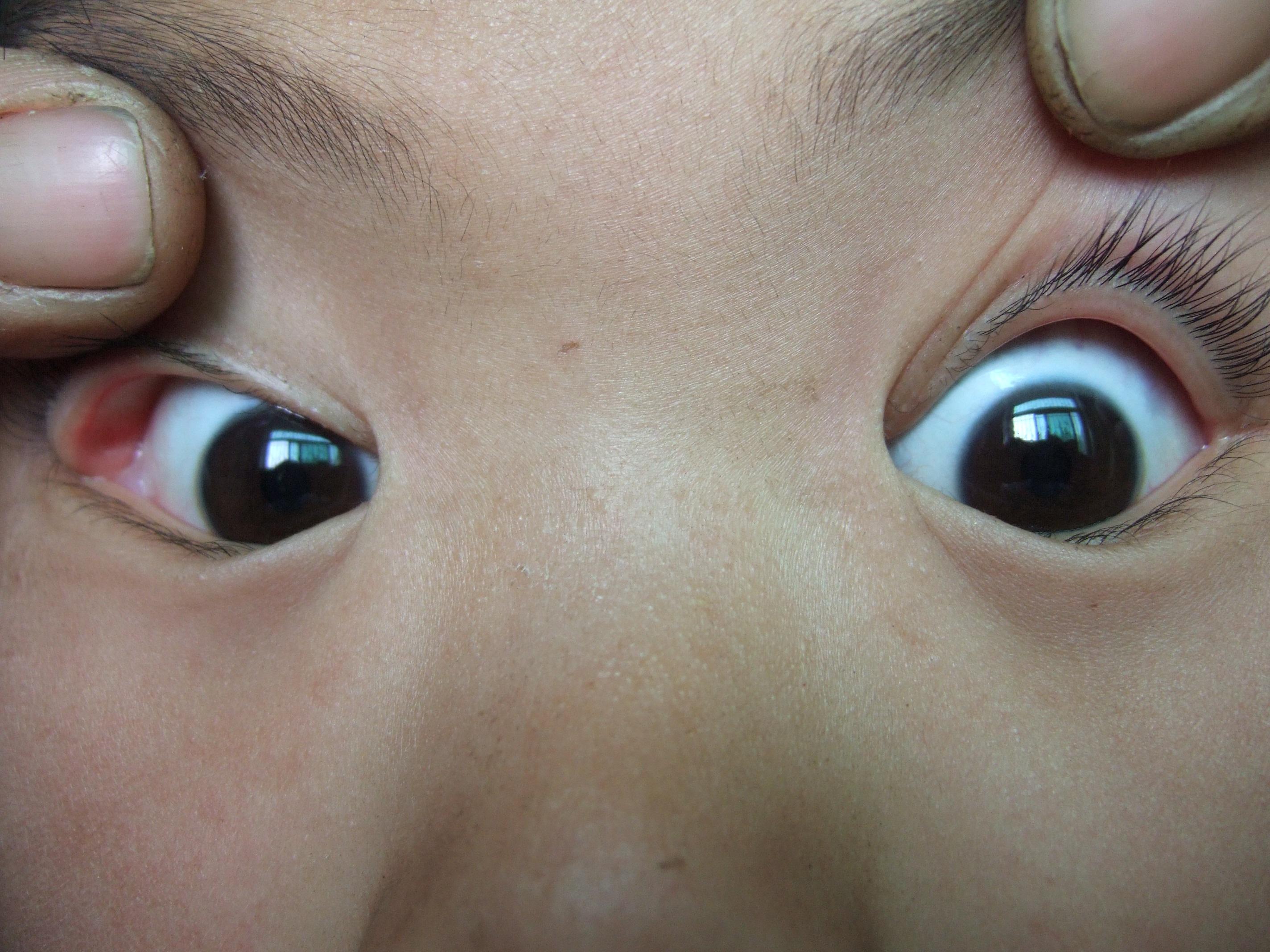 儿童眼睛里有蓝斑图片图片