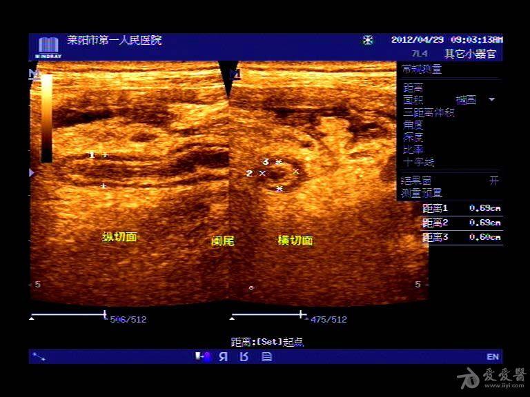 阑尾炎彩超表现图片