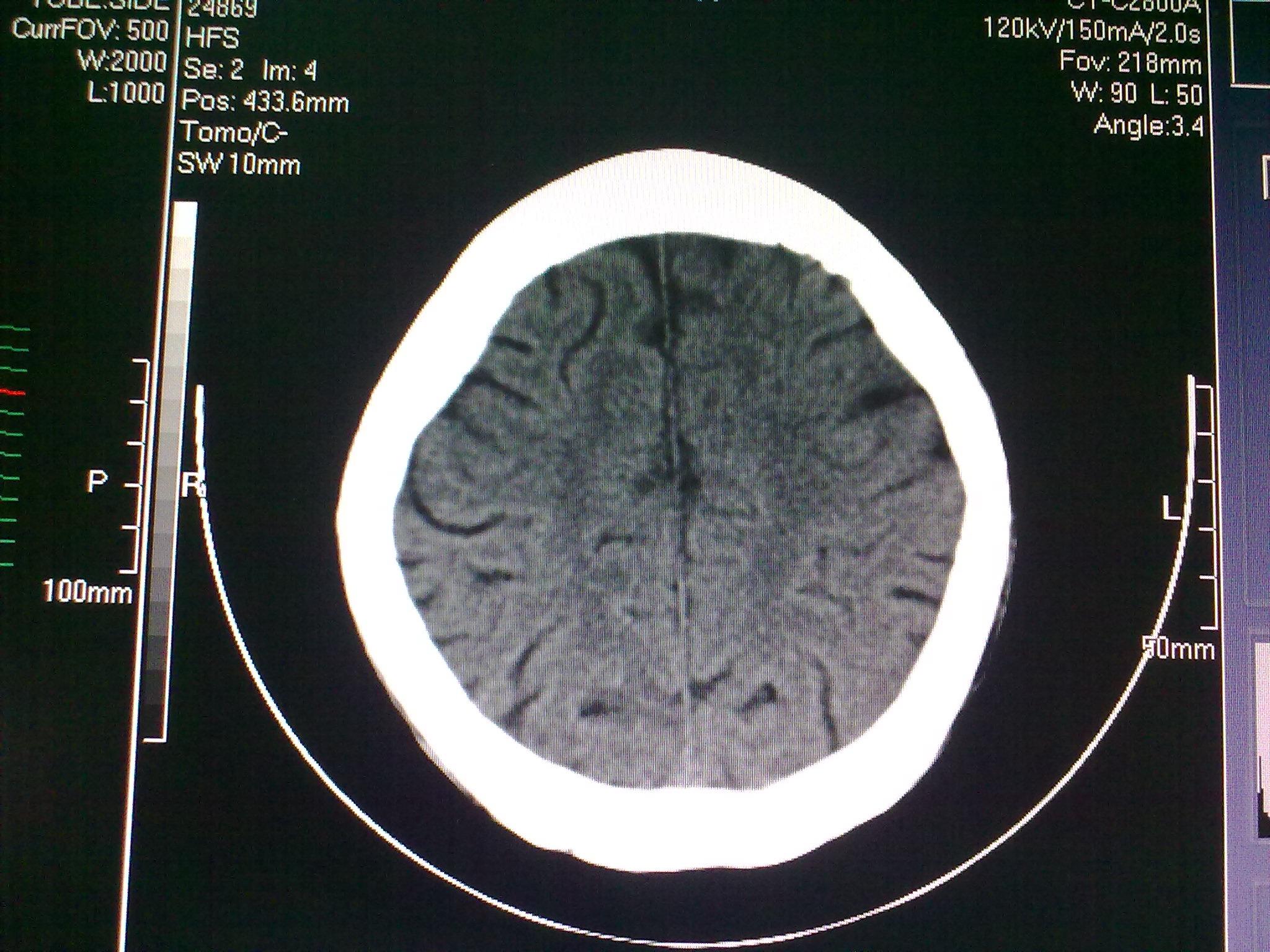 頭部ct - 醫學影像學討論版 - 愛愛醫醫學論壇