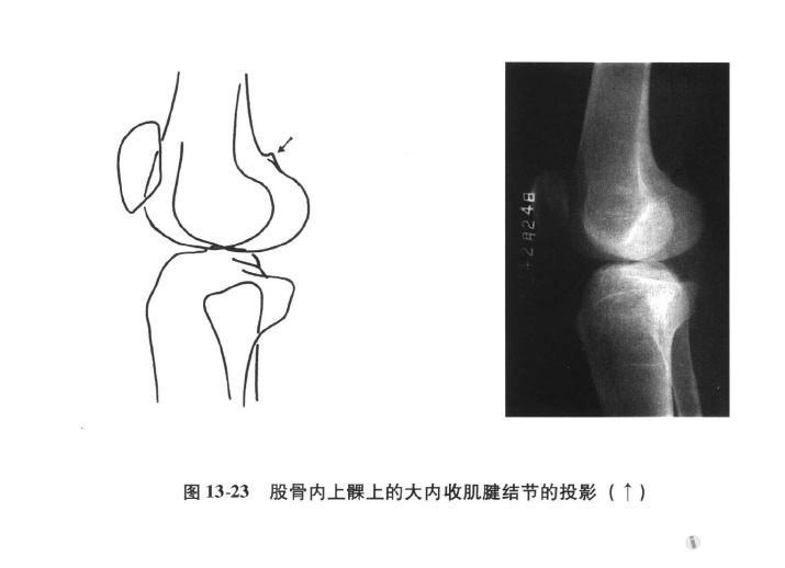 侧位片怎么区分右股骨内外髁