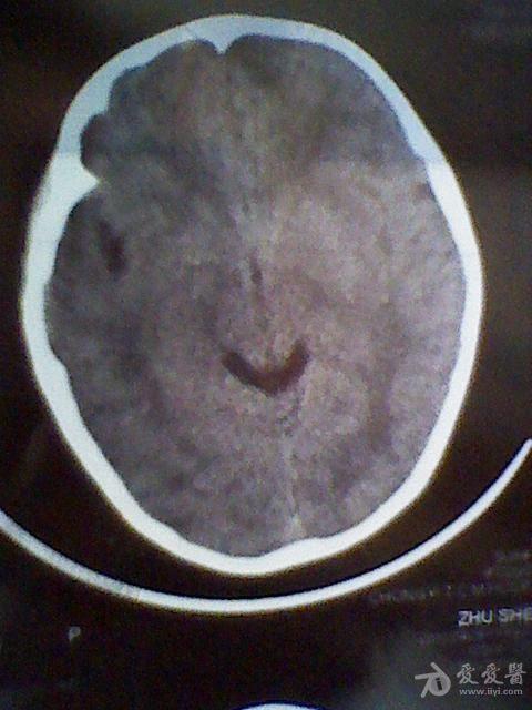 颅骨凹陷性骨折ct 搜狗图片搜索