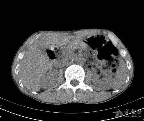 肝内胆管扩张ct图片