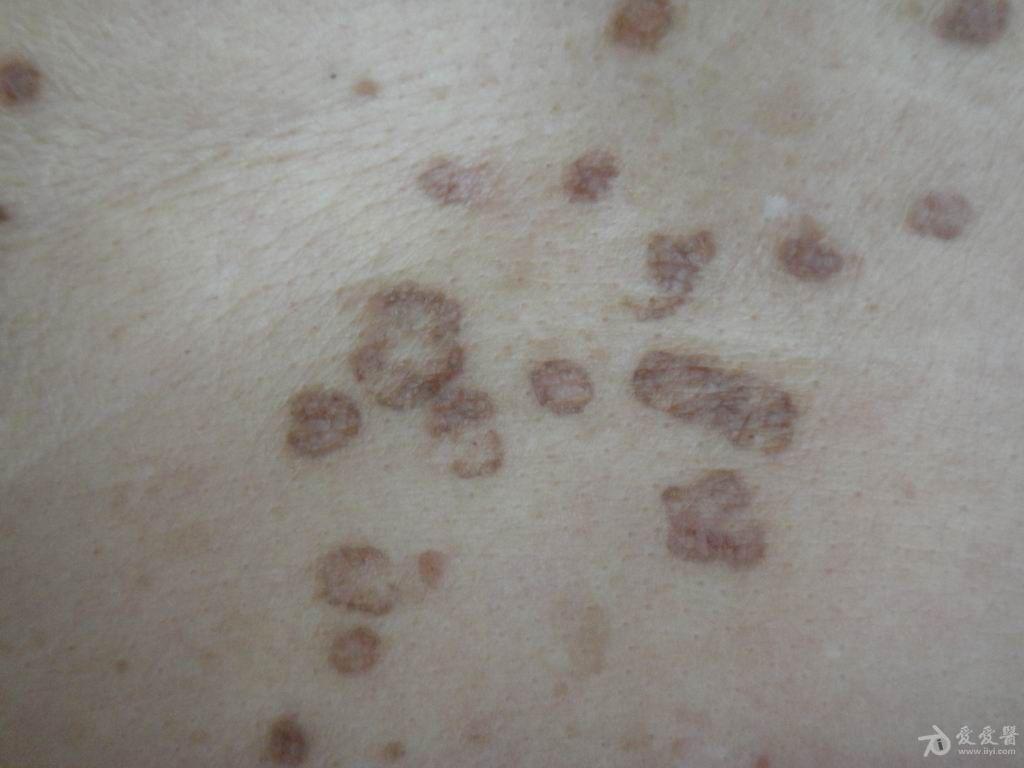 皮肤病汗孔角化症