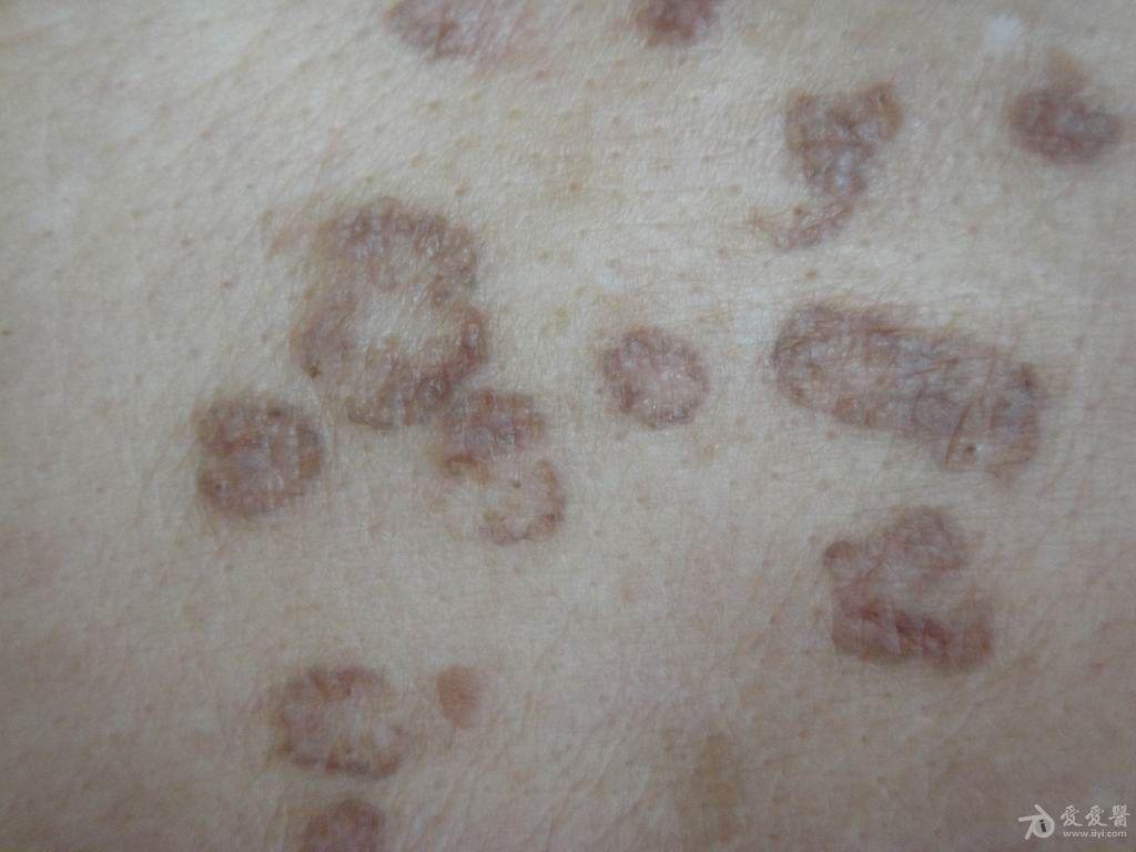 皮肤病汗孔角化症