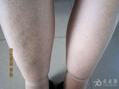 晒病历赢积分活动水能载舟亦能覆舟伲福达致双下肢紫癜一例018号