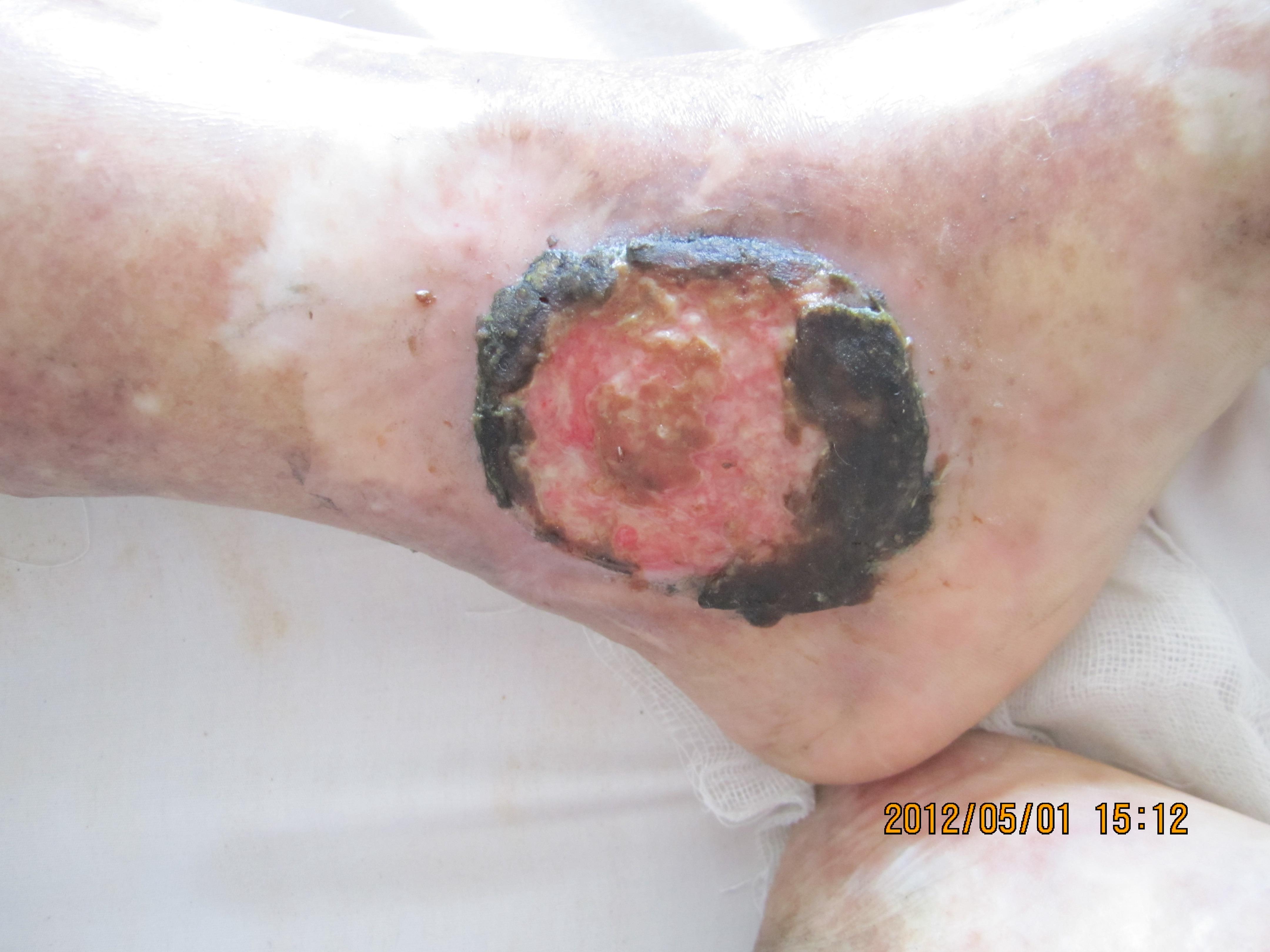 肝癌晚期皮肤溃烂图片图片