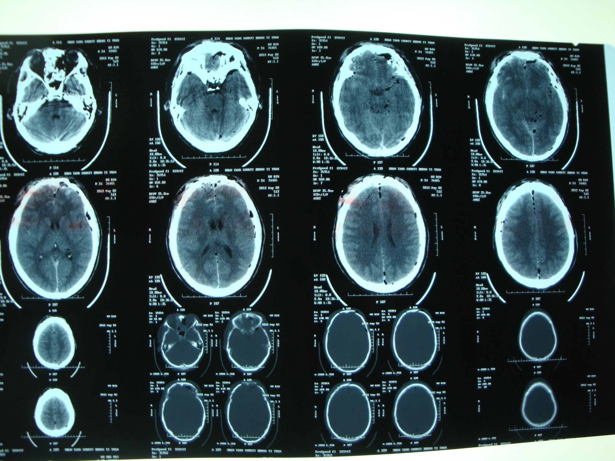 此例颅脑损伤是手术还是保守治疗