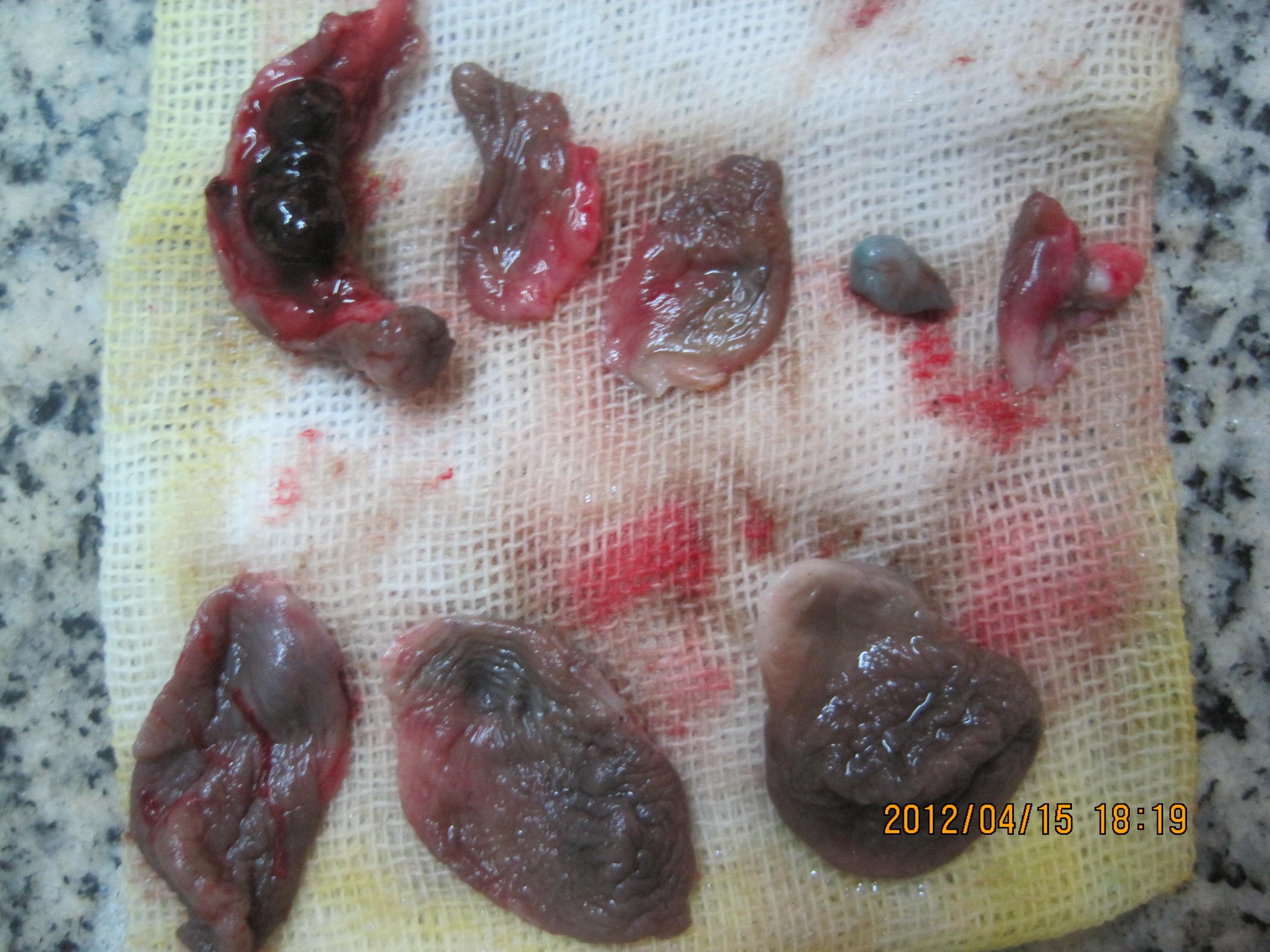 女性痔疮肉瘤图片图片
