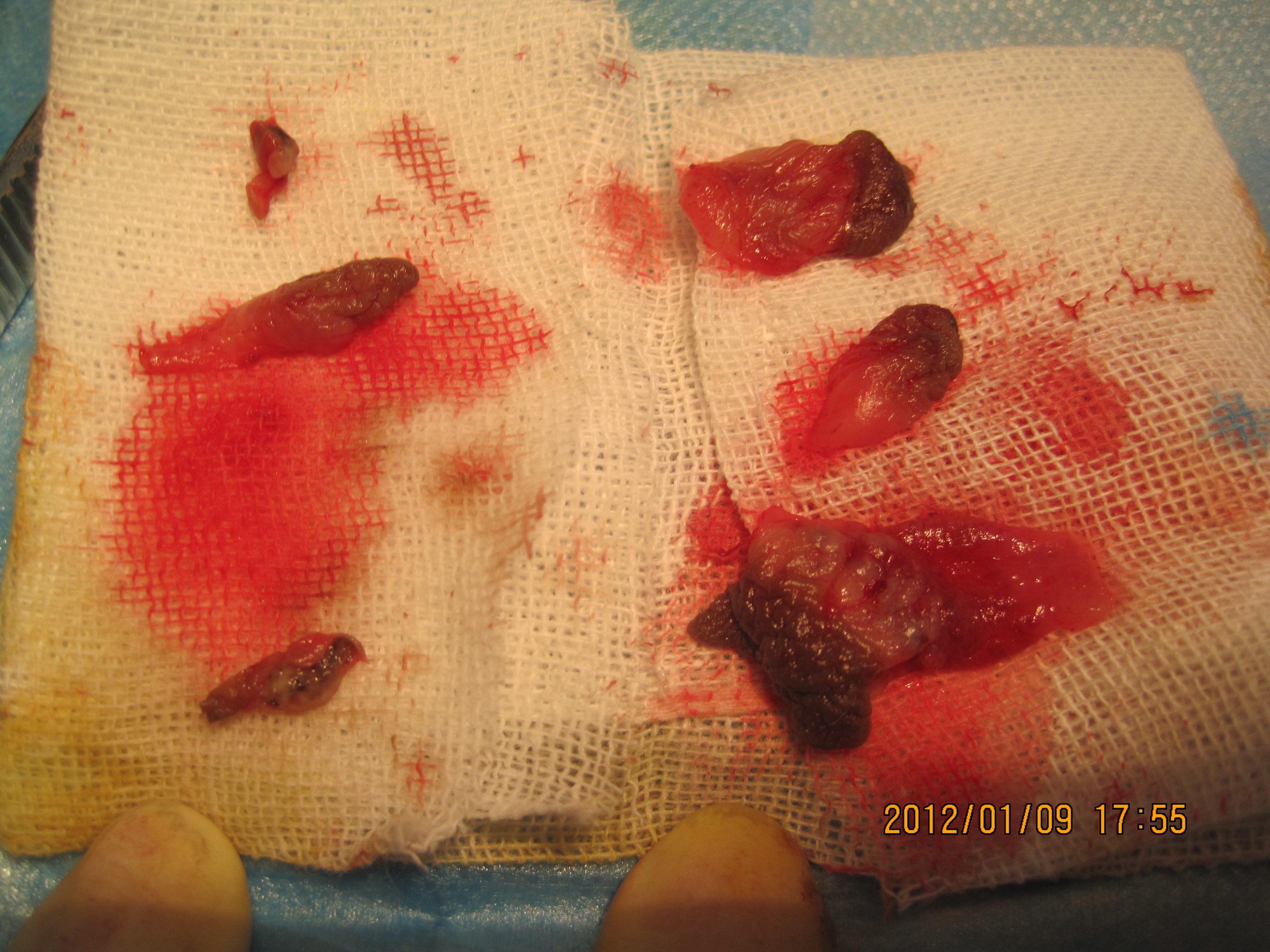 血栓外痔手术图片