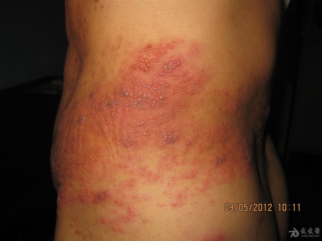 病例分享又一例带状疱疹