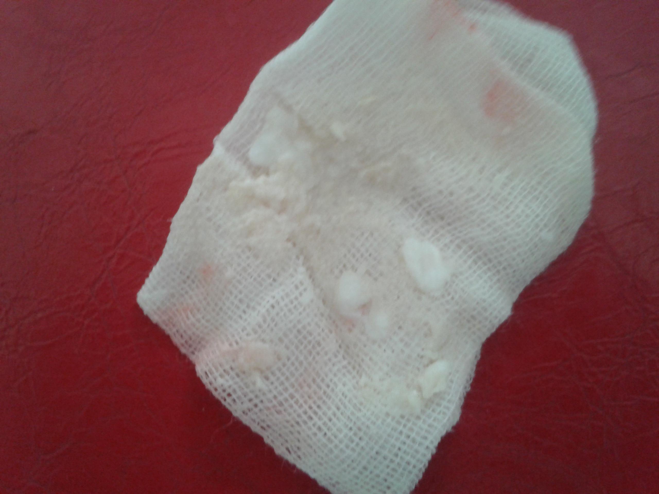 超大的皮脂腺囊肿
