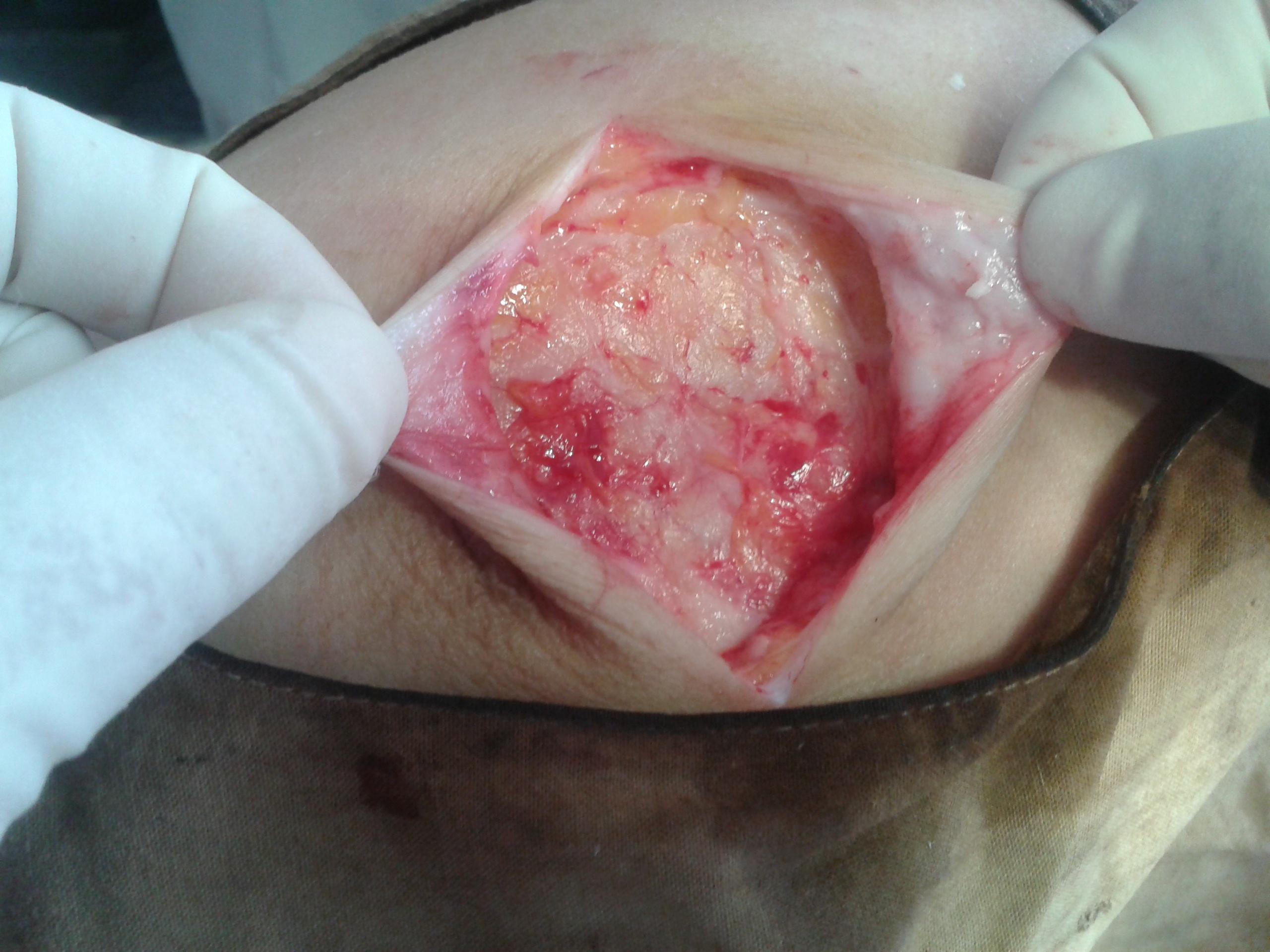 皮脂腺瘤手术图片