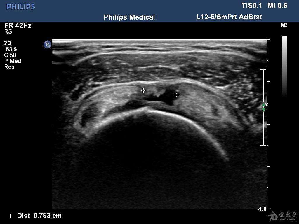 冈上肌腱腱体部分撕裂