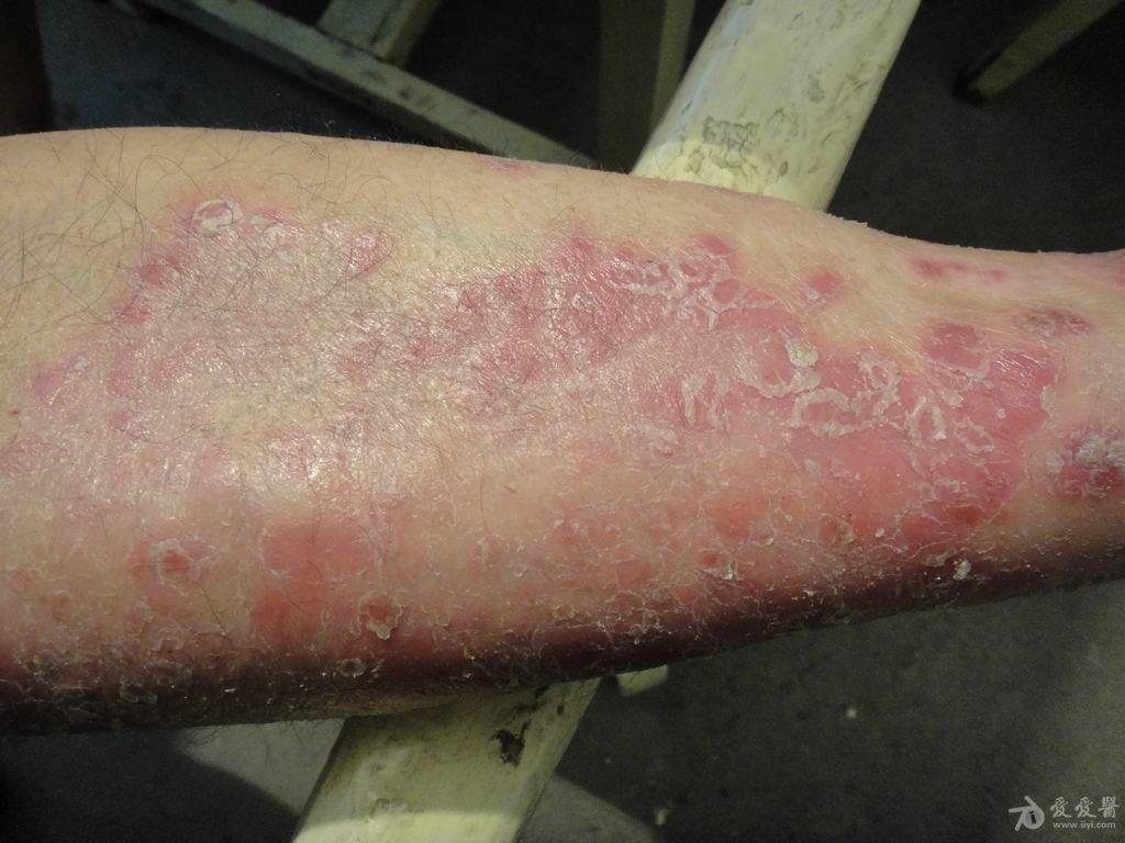 典型皮肤病之银屑病