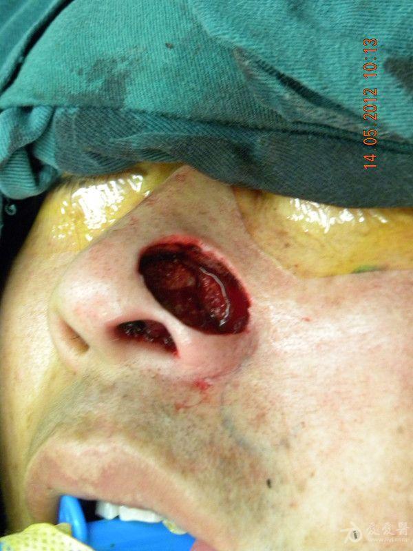 鼻前庭囊肿手术图片
