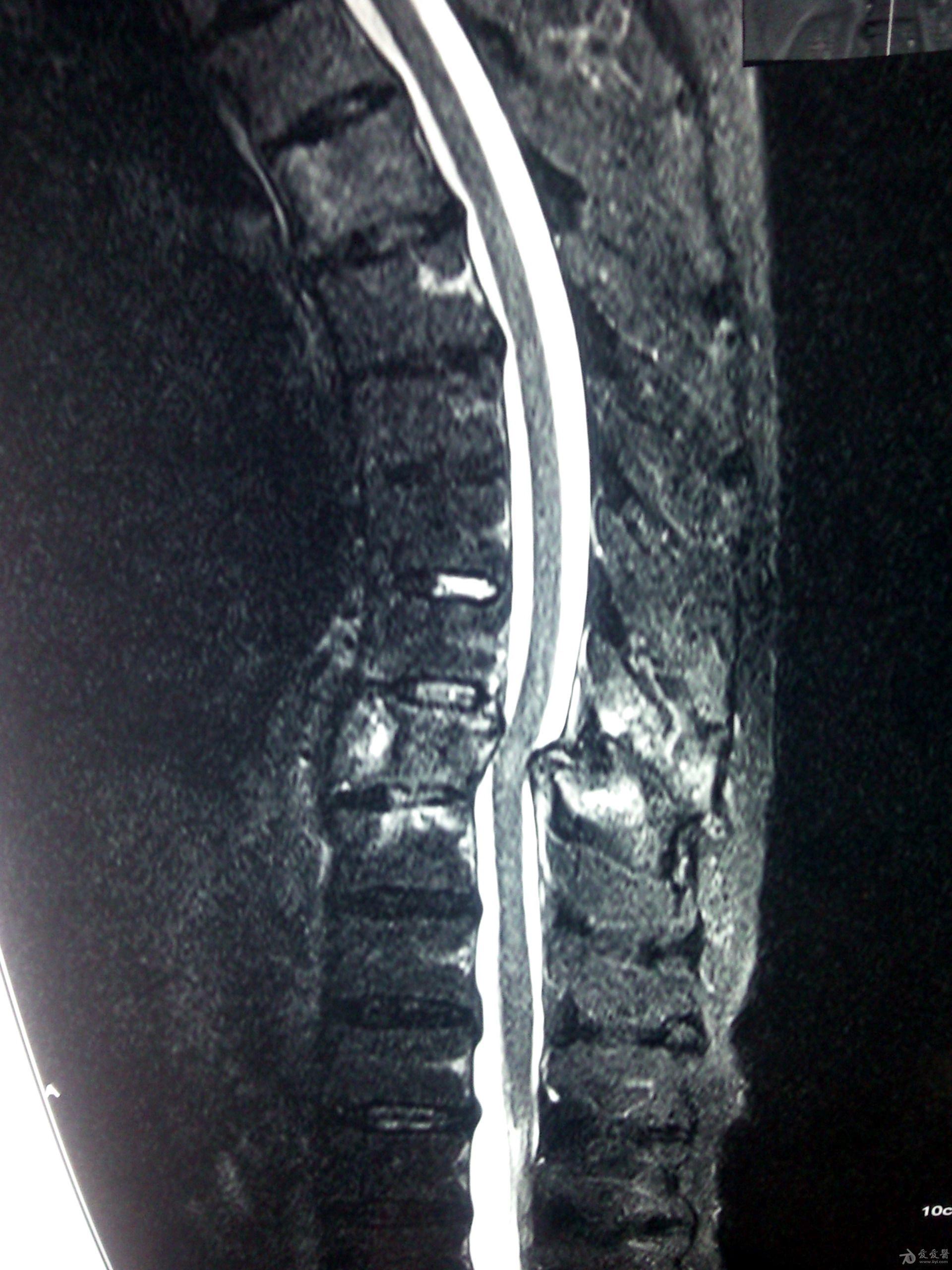 腰3椎体血管瘤怎么办