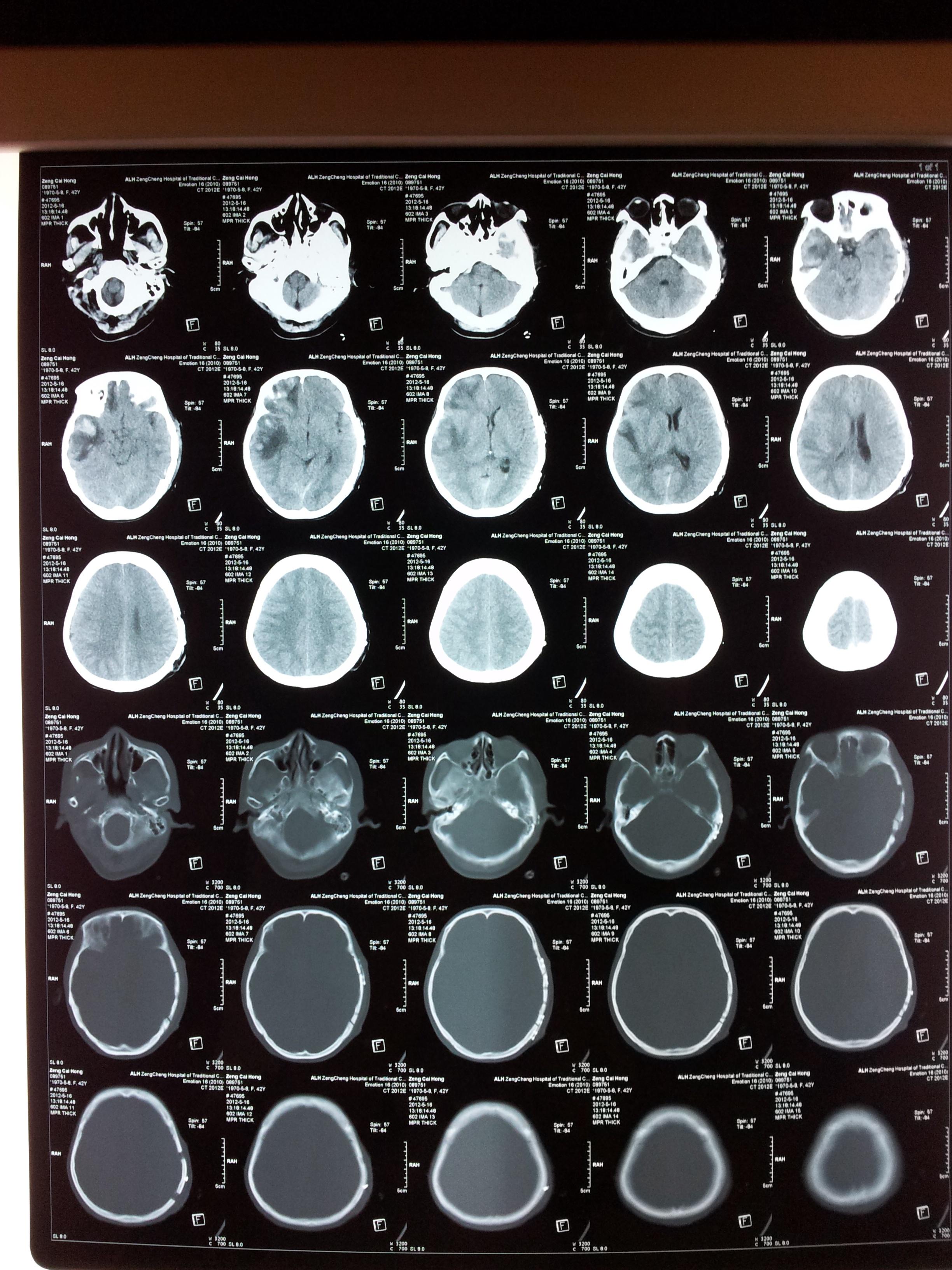 初步诊断:1,急性重型颅脑损伤