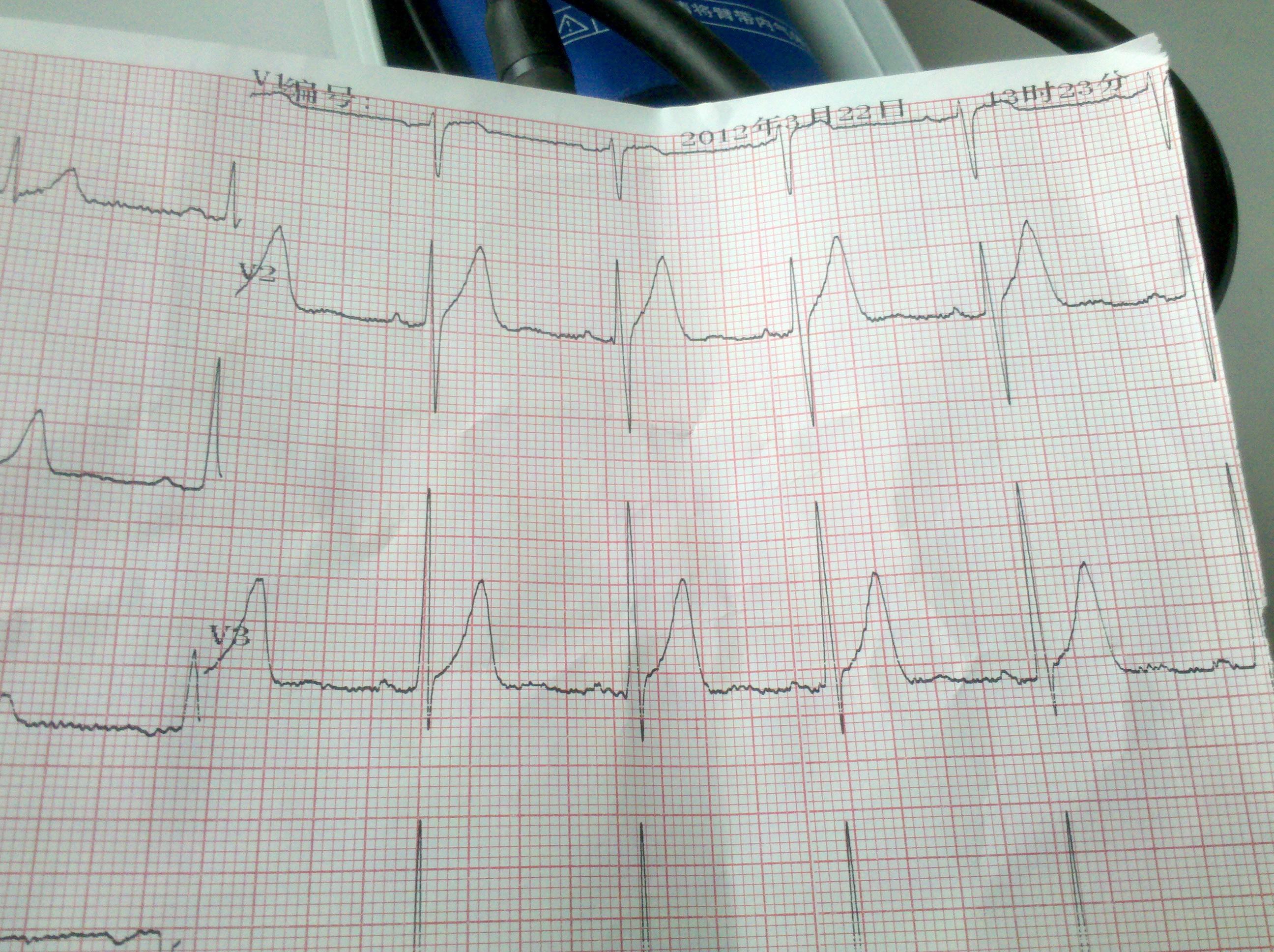 怎么分析st段的j点高还是不高 - 心血管内科讨论版 - 爱爱医医学论坛