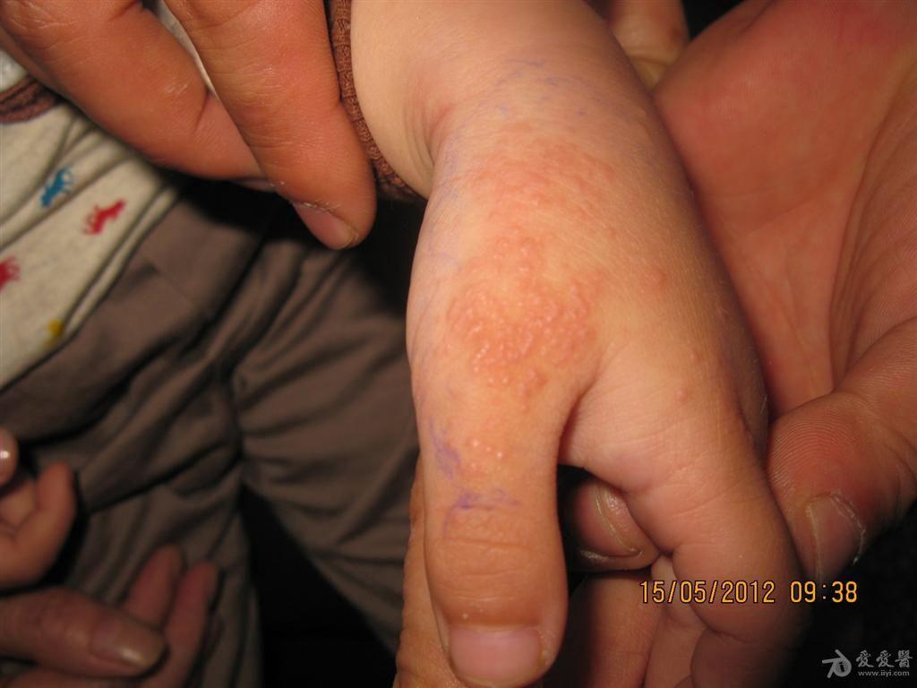 看图识病摩擦性苔藓样疹