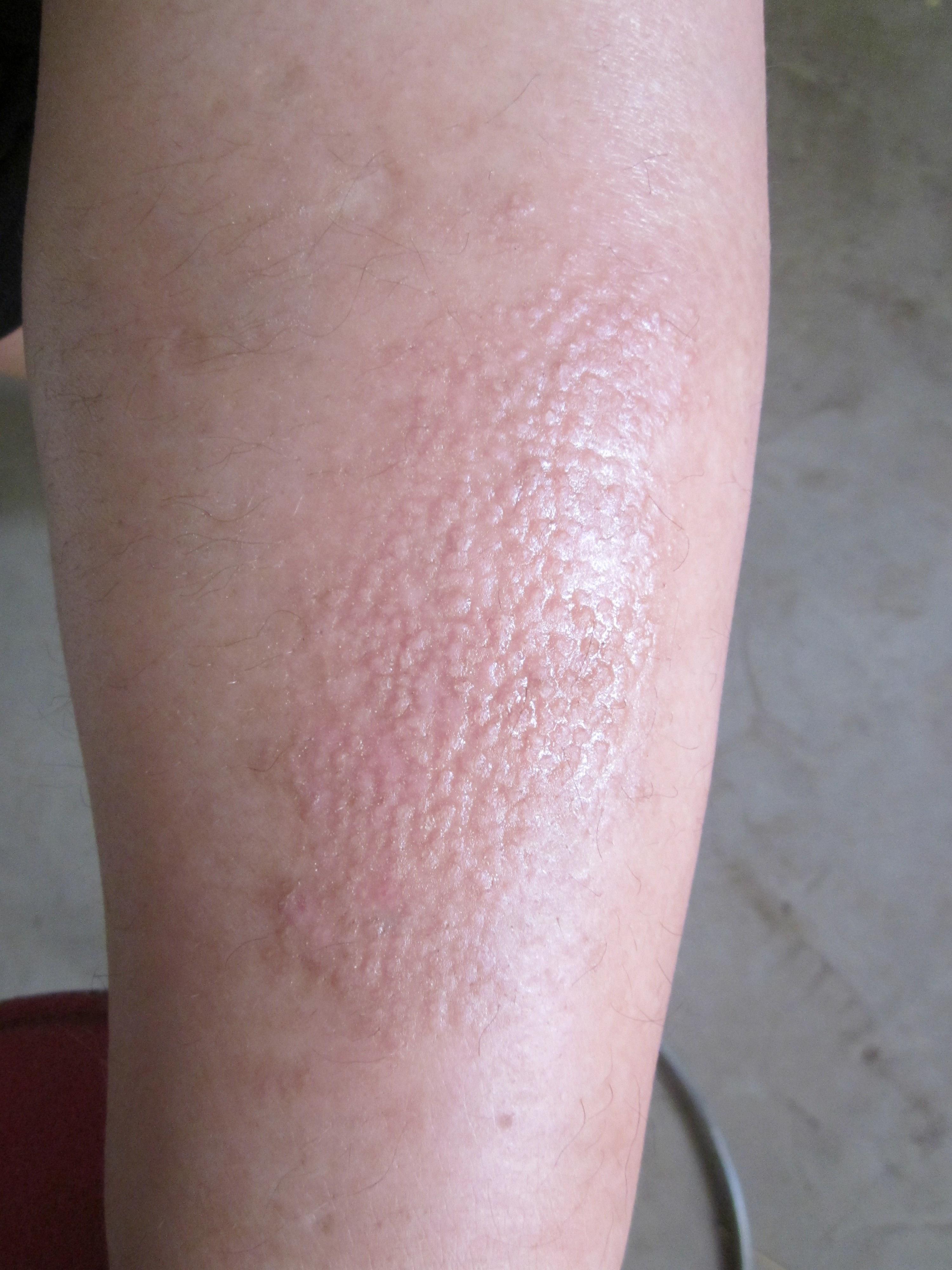 分享图片原发性皮肤淀粉样变