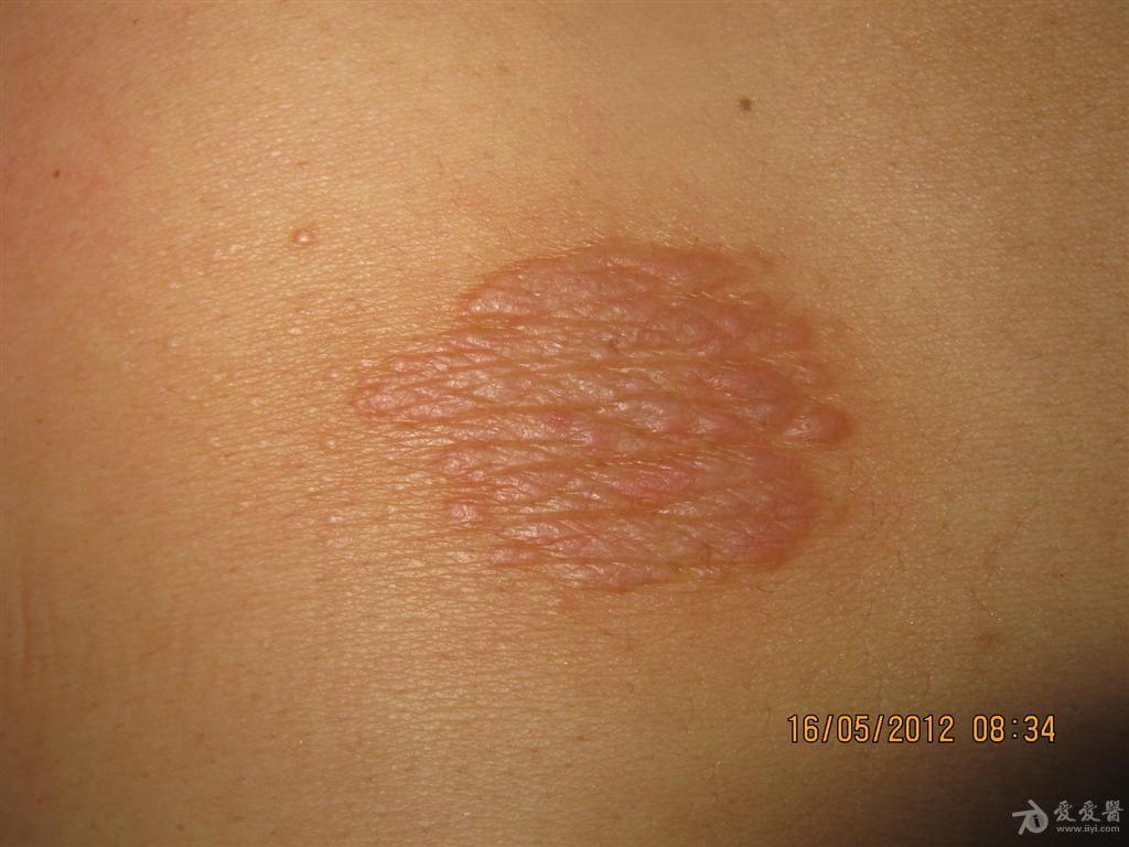 看图识病神经性皮炎