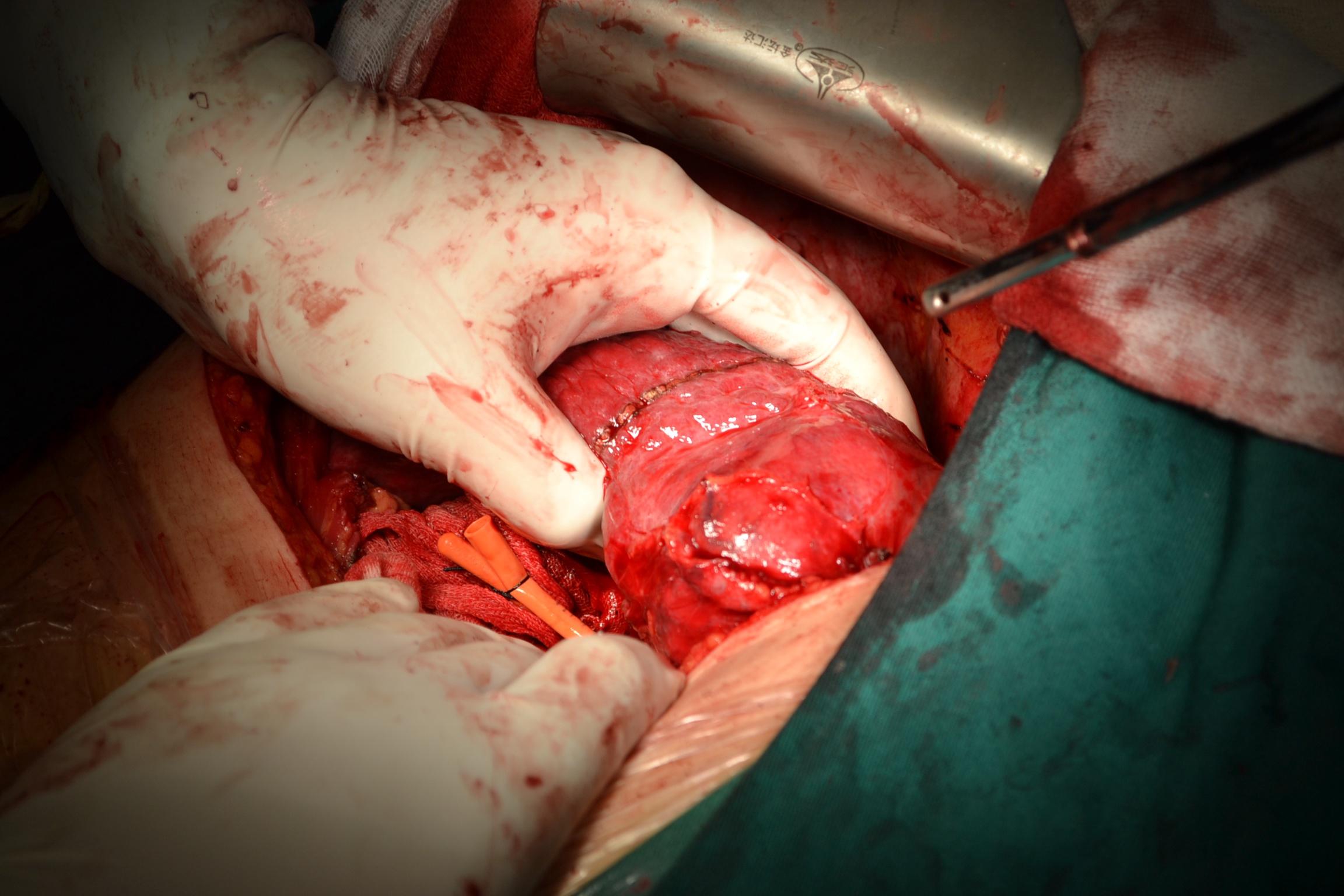 原发性肝癌-方叶切除术-近期手术资料