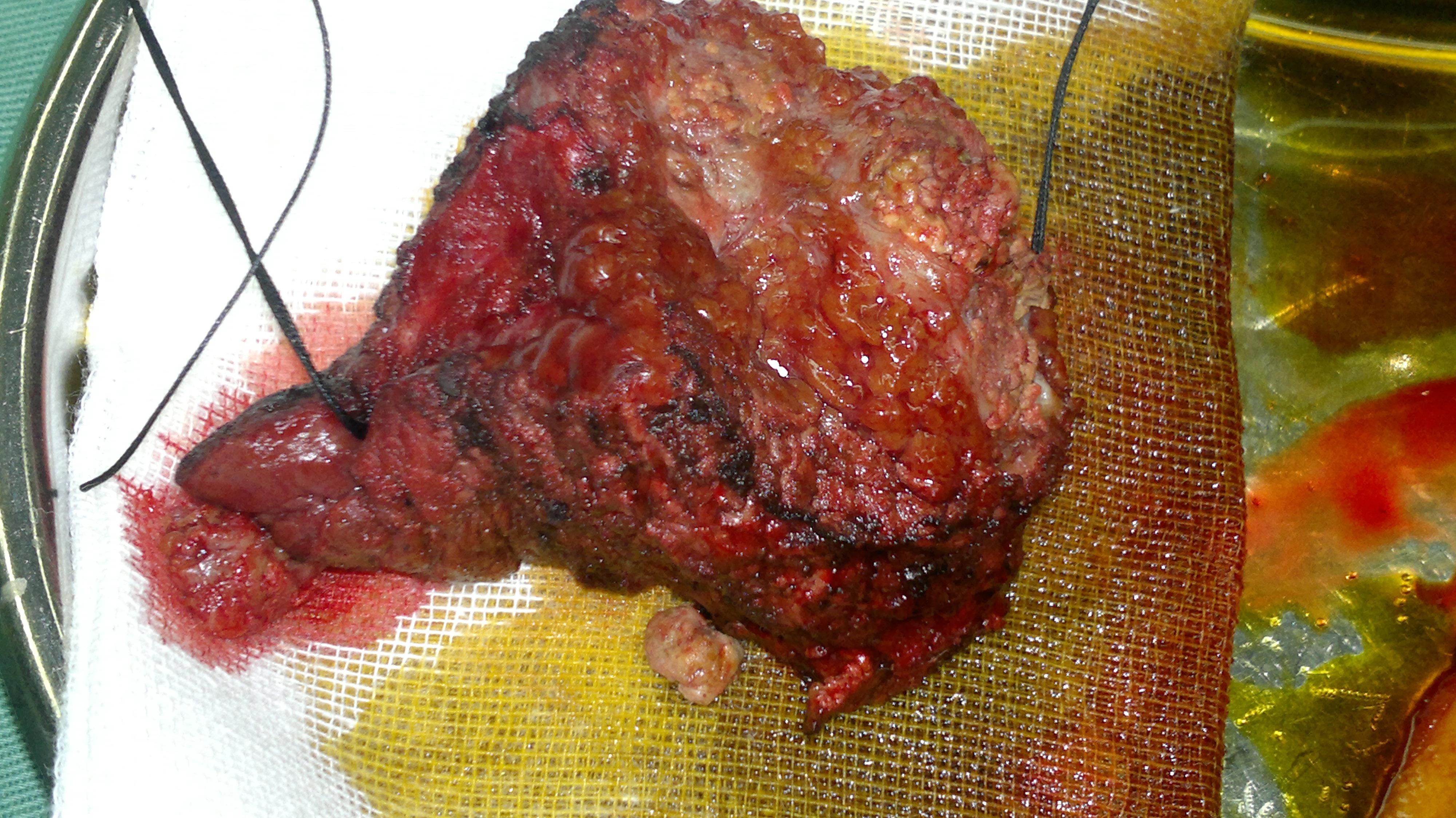 复发肝癌的再切除5段切除术中照片