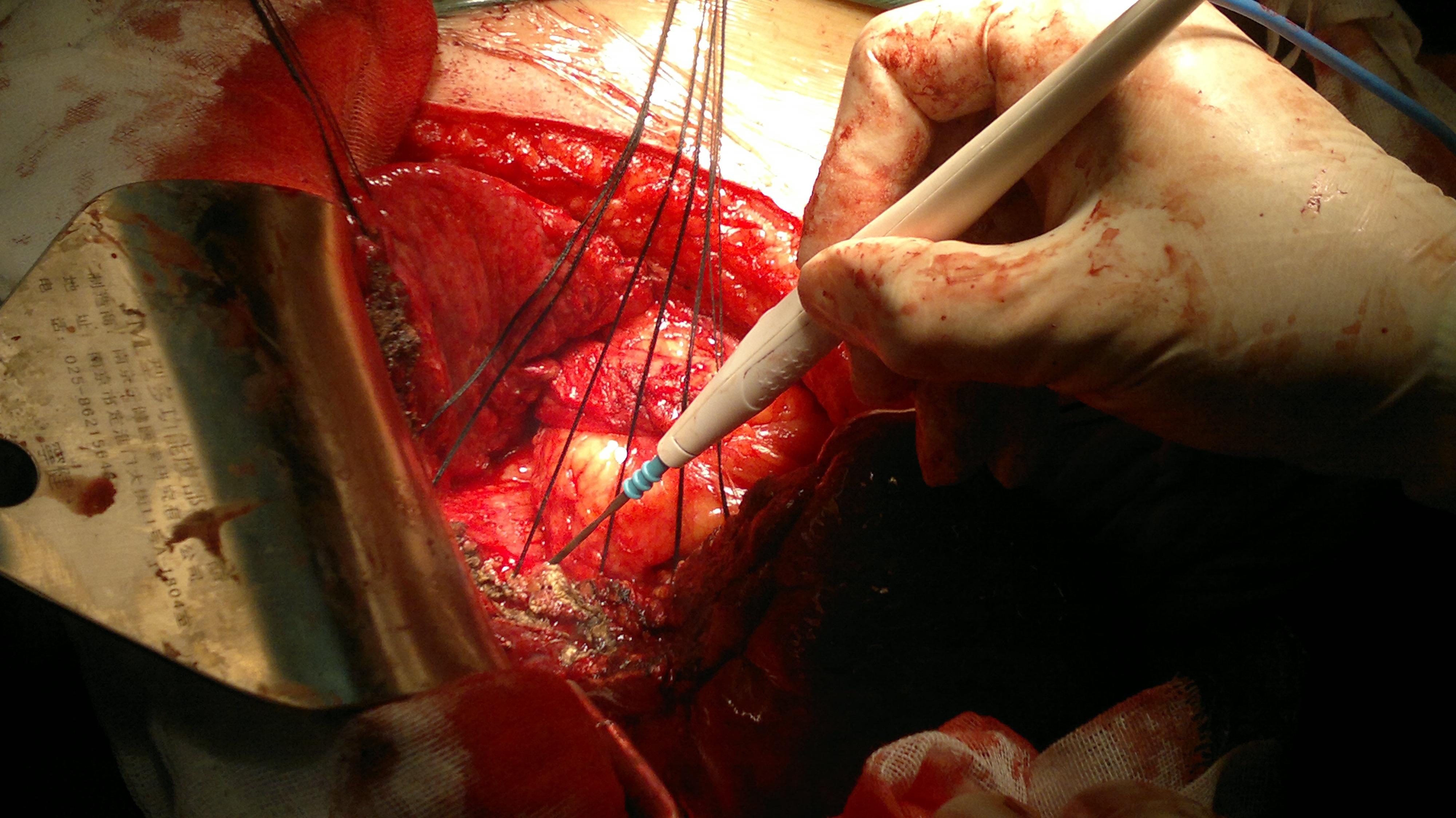 复发肝癌的再切除5段切除术中照片