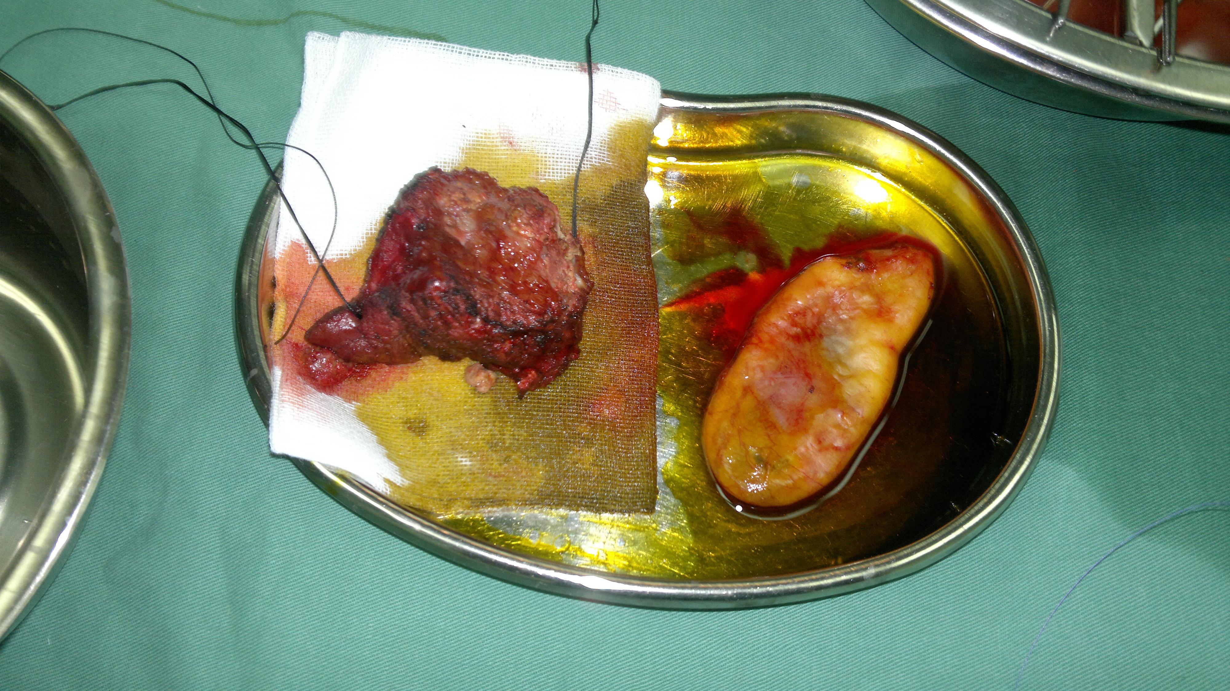 肝癌被切出来的图片图片