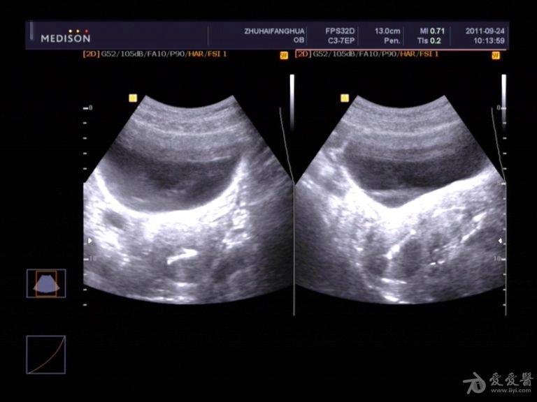 宫内节育环超声图片图片