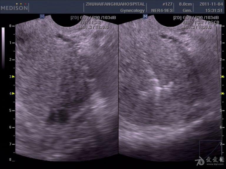 宫内节育环超声图片图片
