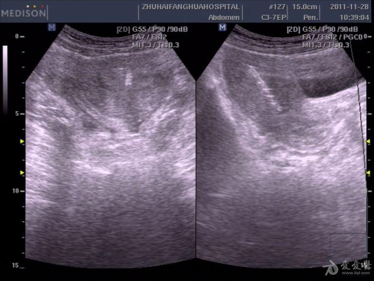 宫内节育环超声图片图片