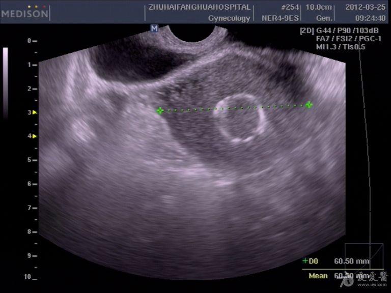 宫内节育环超声图片图片