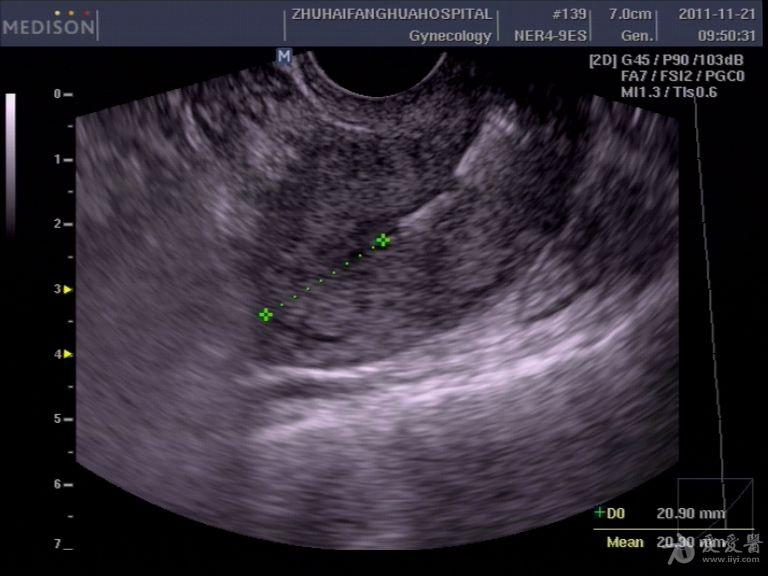 宫内节育环超声图片图片