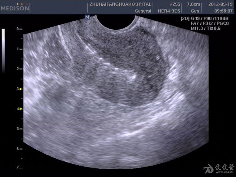 宫内节育环超声图片图片