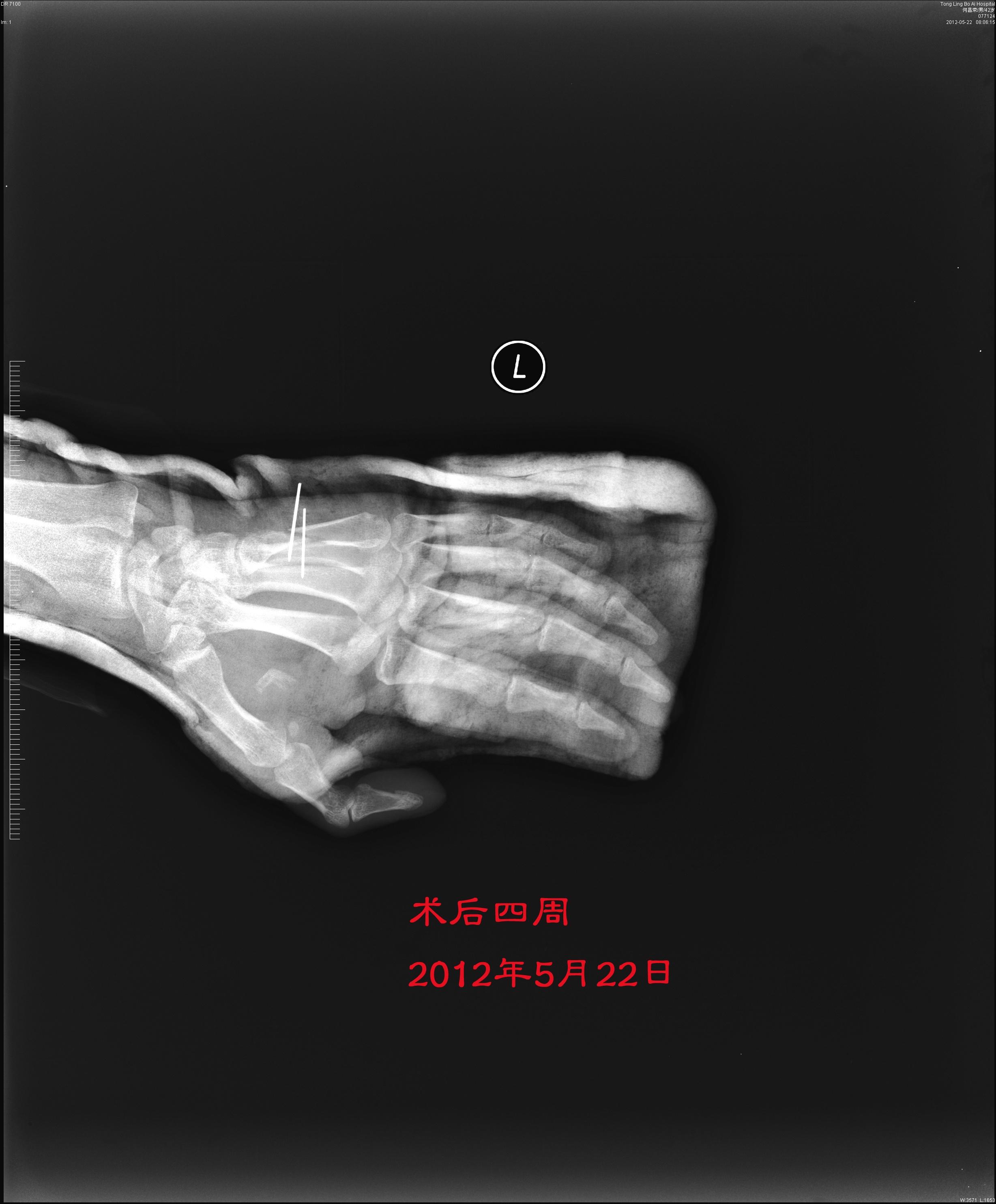 开放性第五掌骨长斜型骨折克氏针固定是否需要重新固定