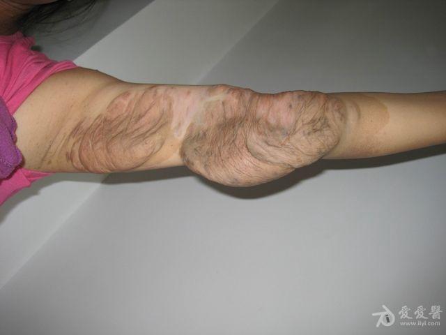 看图识病,神经纤维瘤病