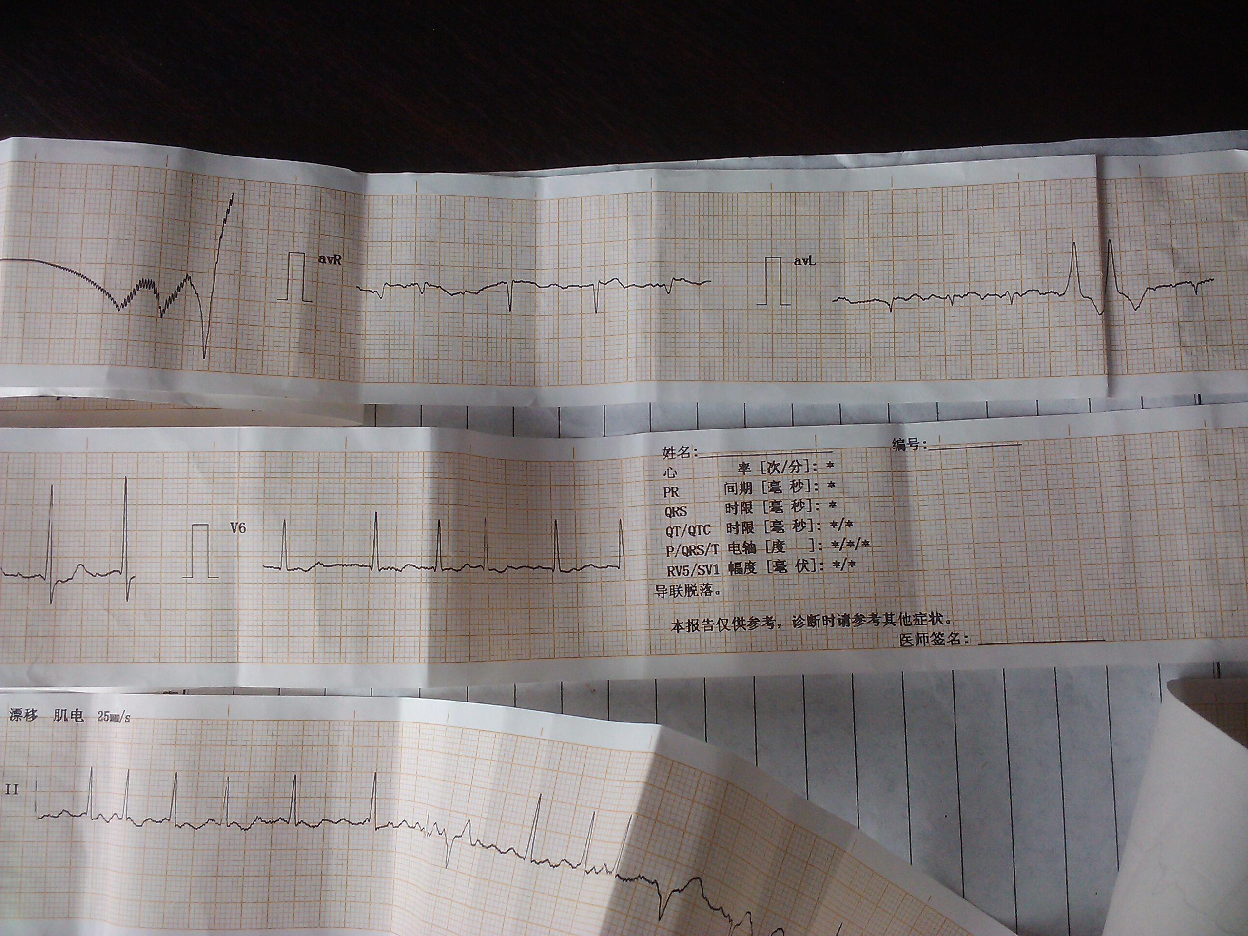 老年女性心电图是快速房颤伴阵发性室速